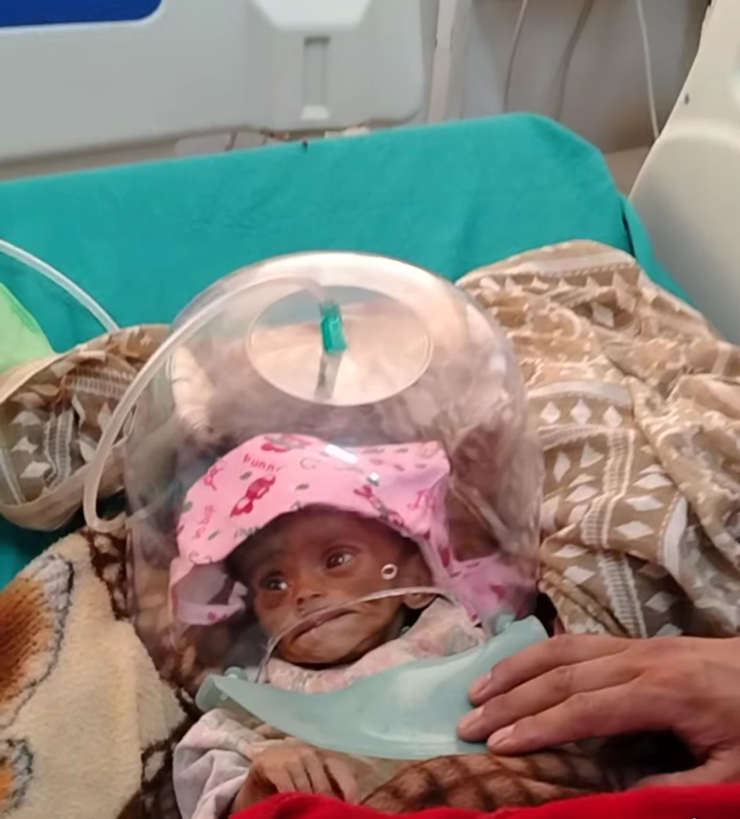 कुपोषणका कारण २ महिने बालिकाकाे अस्पतालमा नै मृत्य