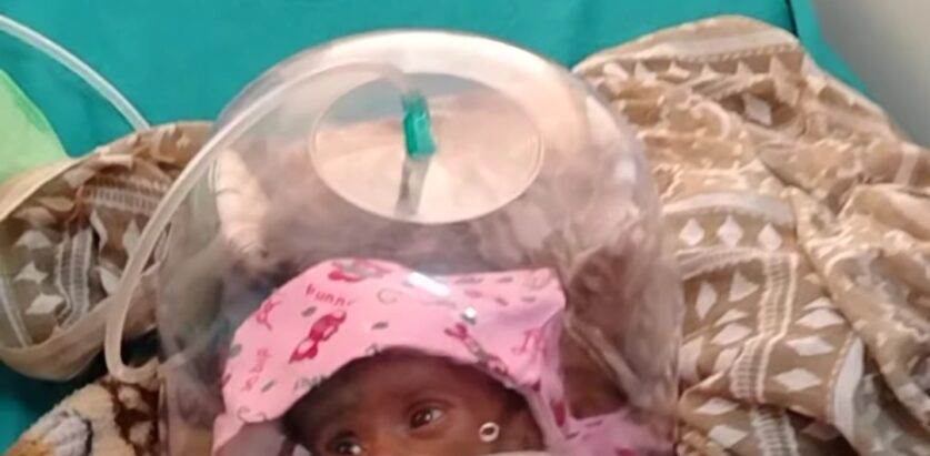 कुपोषणका कारण २ महिने बालिकाकाे अस्पतालमा नै मृत्य